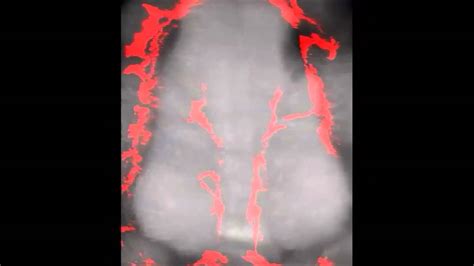 Crogvabnormal umbilical cord blood vessels. PLoS ONE : Angiogenesis in the Developing Spinal Cord ...