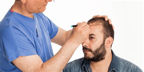 Stem cell hair transplants offer options to people who aren't candidates for the hair loss treatments currently available. All You Need To Know on Stem Cell Hair Transplant | NJHRC Blog