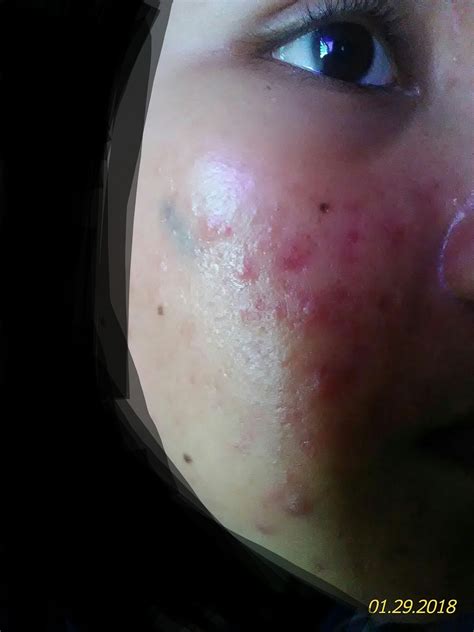 Maybe you would like to learn more about one of these? Cara Nak Hilangkan Muka Breakeout Teruk