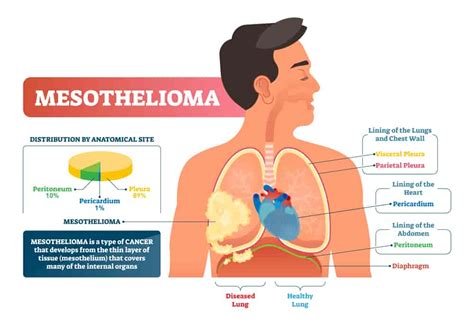 Mesothelioma is divided into three cell types: Mesothelioma causes, symptoms, diagnosis, treatment, and ...