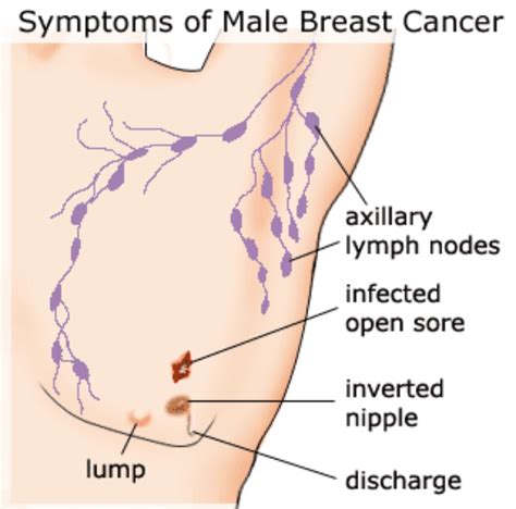 Between 1990 and 2000, the mortality of women diagnosed with breast cancer between the ages of 30 to 79, fell by 24% and by 2007, for all women between 15 and 99, survival was 98.8% at one year, 85.1% at five years and 77% at 10 years. David Samadi, MD - Blog | Prostate Health, Prostate Cancer ...