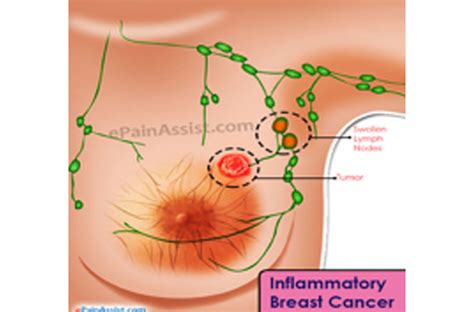 So few people have heard of this type of cancer. Inflammatory Breast Cancer