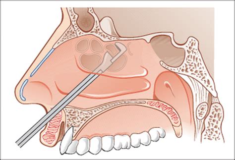 The speculum is used to perform an anterior rhinoscopy. Standard Operations for Acute and Chronic Sinusitis | Ento Key