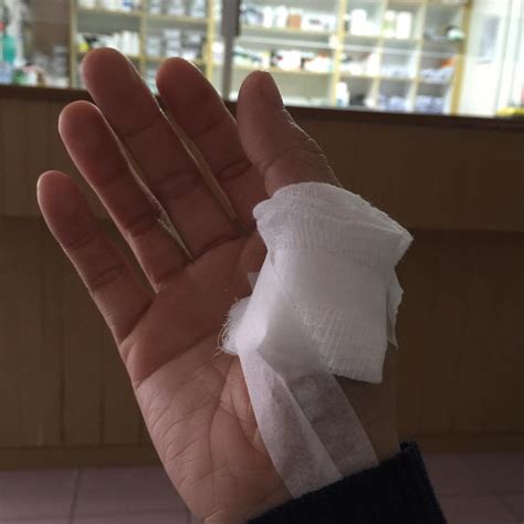 Tangan adalah bagian tubuh yang paling penting untuk melakukan aktifitas. Sakit Ibu Jari Tangan , AHTRISTIS kah aku