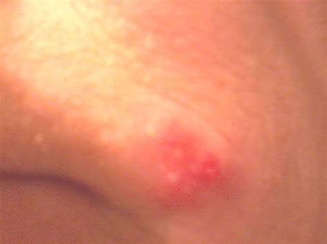 I was told a few days ago that i have herpes. Pin on My Rash & Labs Pix