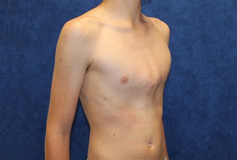 Pectus carinatum is an uncommon birth defect in which a child's breastbone protrudes outward abnormally. Pectus Carinatum - Causes, Symptoms, Brace & Surgery Treatment