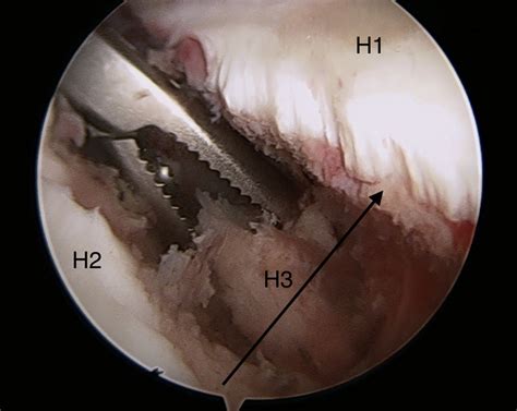 Arthroscopic Reduction and Fixation of Transverse Intra ...