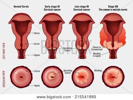 That means the birth canal is your cervix has elongated and the uterus has contracted fully so that you can give birth to the baby. Cervical Cancer Vector & Photo (Free Trial) | Bigstock