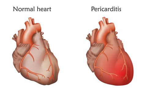 Pericarditis is a relatively common heart condition. Pericarditis - Types, Symptoms, Causes, Treatment and Prevention