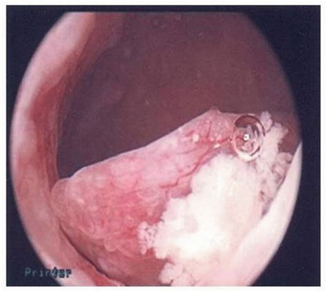 Finding cancer early, when it's small and hasn't spread, often allows for more treatment options. Endometrial cancer in polyp Endometrial cancer in polyp