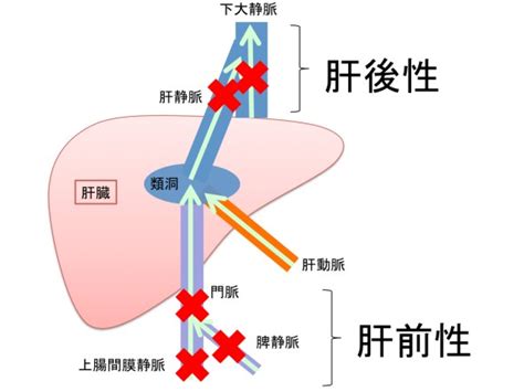 【保存版】門脈圧亢進とは？原因、症状、治療のまとめ ...