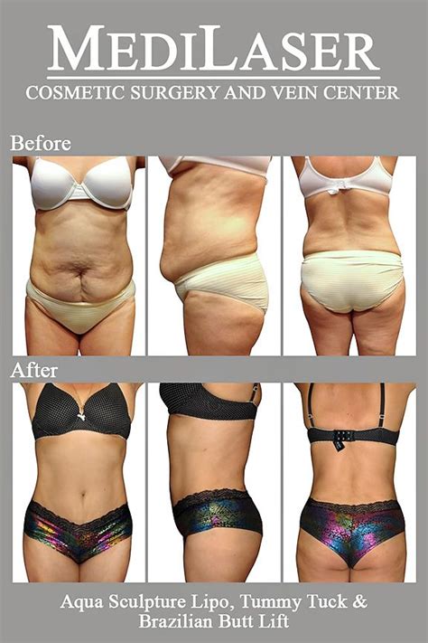 Maybe you would like to learn more about one of these? Pin on Medilaser Tummy Tuck | Abdominoplasty