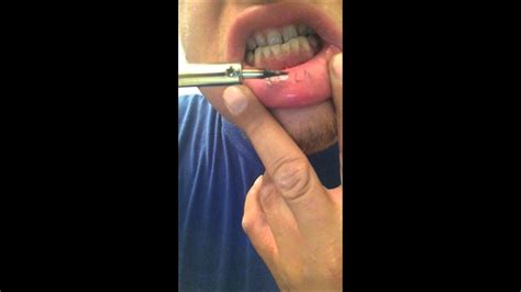 Please be careful though, all the metal part is burning hot ! Crazy stupid dad homemade tattoo removal burns off tatto ...