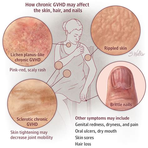 Three of the dogs showed no clinical signs, six had up to three clinical signs and six had more than three. Graft-vs-Host Disease | Allergy and Clinical Immunology ...