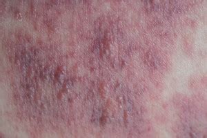 Dermatite atopica grave dell'adulto. Dalla perdita del ...