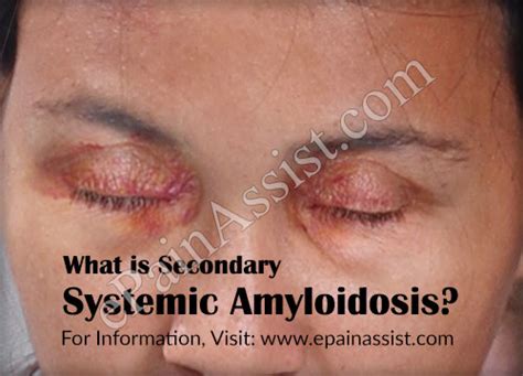 Systematic risk can be defined as a type of total risk that arises as a result of various external factors such as political factors, economic factors, and sociological factors. What is Secondary Systemic Amyloidosis|Causes|Symptoms ...