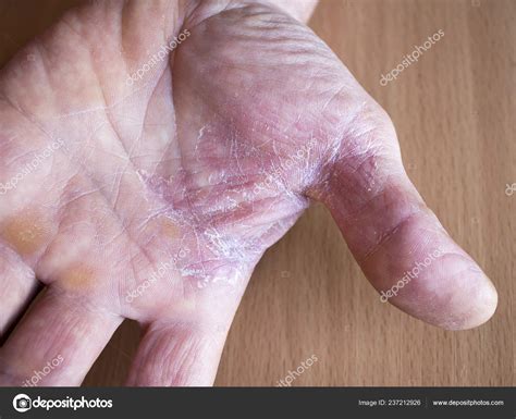 Peeling Dry Skin Hands Concept Treatment Prevention Skin Diseases ...