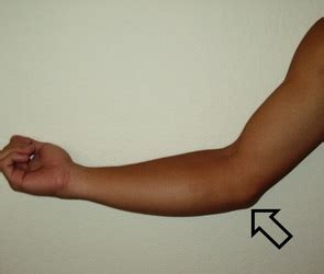 Elbow joint consists of two articulations. Signs & Symptoms - Ulnar Collateral Ligament Sprain