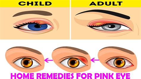 Can pink eye become more serious? Home Remedies for Pink Eye | How to Get Rid of Pink Eye ...