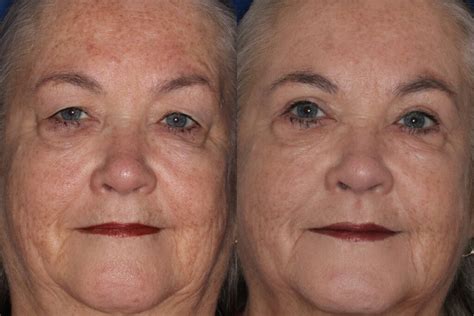 Maybe you would like to learn more about one of these? Eyelid Surgery Portland | Blepharoplasty Portland | EHNPC
