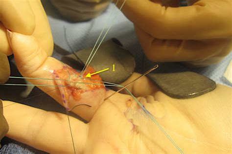 Occupational therapist discusses function of fds and fdp tendons. FLEXOR TENDON LACERATION | Hand Surgery Source