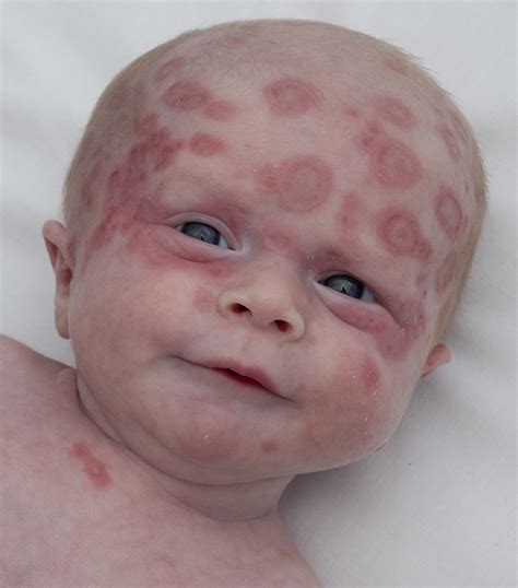 Lupus is a complex and potentially serious autoimmune condition. A neonate with a rash | The BMJ