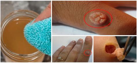 The exact cause of fibroid tumor is not known, but the possible causes are believed to be: Jangan Panik Jika Tubuhmu Dipenuhi Tumor Fibroid/Kulit ...