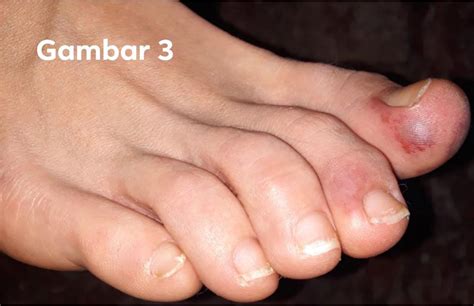 Berikut contoh foto gambar rumah idaman terbaru sebagai inspirasi anda dalam menentukan desain rumah minimalis modern sederhana yang cocok untuk rumah idaman anda. "Acure Acro Ischemia" Penyakit Ruam Di Kaki Kanak-kanak ...