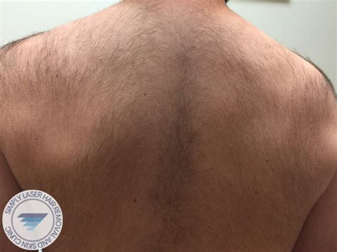 How to choose the best at home laser & ipl hair. Laser Hair Removal for Men