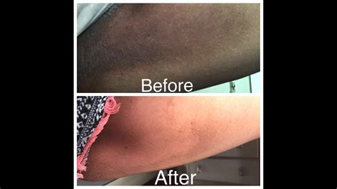 Add more radiance to your daily skin care routine and minimize the look of dark spots. Get rid of dark inner thighs in just 5 days very easy home ...