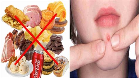 Hal ini bisa menyebabkan banyak reaksi alergi, peradangan, dan makanan diatas tidak selalu buruk bagi anda, apabila dikonsumsi dalam jumlah yang tidak berlebihan. Inilah makanan yang dapat menyebabkan tumbuh nya jerawat ...