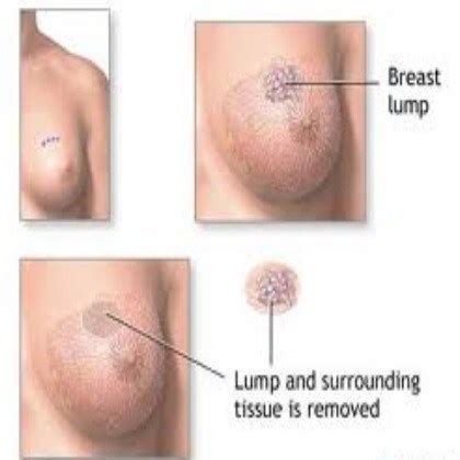 Breast pain and breast cancer in men Breast Lumps Home Remedies, Natural Treatments And Cures ...