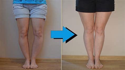 You do not have any obvious structural problems in the legs. knock knees- how to fix knock knees with exercises ...