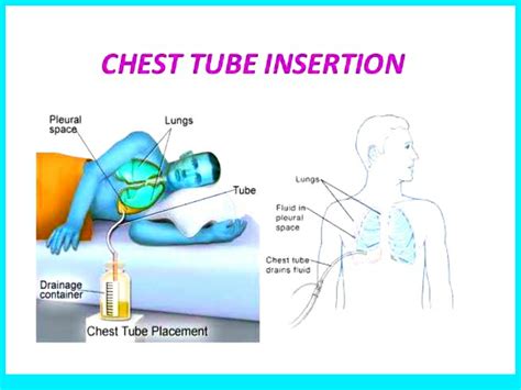 It is encouraged for use in all cases of pleural effusion requiring chest drain except for empyema and other loculated pleural effusions, where it has low success rates. CHEST TUBE INSERTION AND MONITORING - Nurses note help