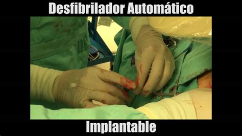 Проверьте 'desfibrilador automático implantable' перевод на английский. Desfibrilador Automático Implantable - YouTube