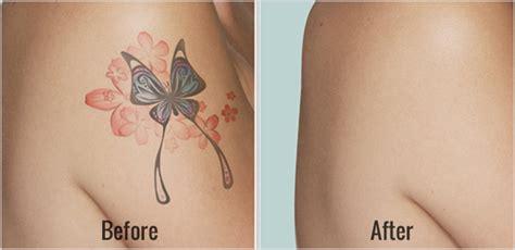 For more images and information about my tattoo laser removal sessions, visit my website, where i take you through each of of my 18 treatments since 2013. Laser Tattoo Removal Before and After