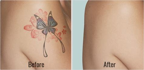 It is safe for all skin tones and works on virtually all inks. Laser Tattoo Removal Before and After