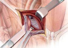 Das innere des leistenkanals passieren direkte leistenbrüche nicht. Chirurgie, um Leistenbruch zu entfernen | Kompetent über ...
