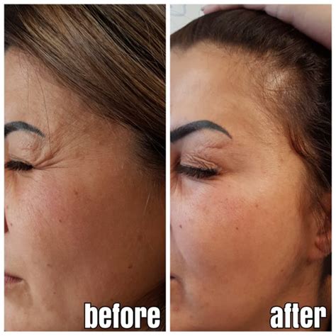 Botox entfernt wirkungsvoll die stirnfalten, die zornesfalten sowie feine augenfältchen. Galerie | Dr. Aesthetik