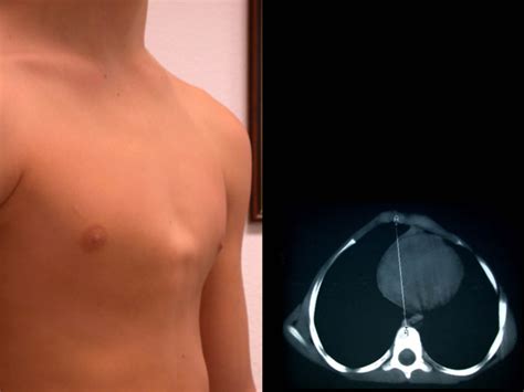 Pectus carinatum, otherwise known as a pigeon chest, refers to a chest wall deformity in which the sternum protrudes anteriorly. Pectus Carinatum - Pectus Forum