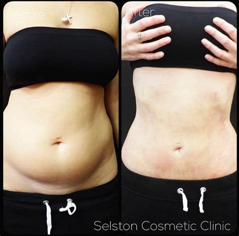 The higher your mah, the longer the battery lipos are a great and quick way to gain an advantage on the battlefield. Selston Cosmetic Clinic: Remove Unwanted Fat With Vaser ...