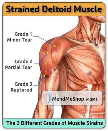 See a picture of the spine. Deltoid Strain