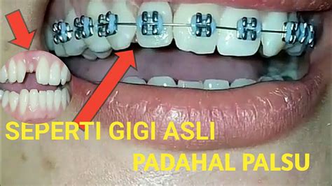 Ü garansi pasang nyaman puas. PASANG BEHEL PADA GIGI PALSU - YouTube