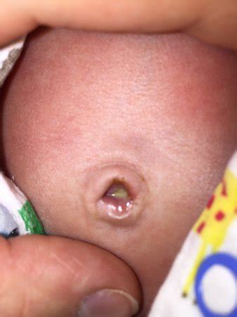 After the umbilical cord stump dries up, falls off, and the area heals, you can start giving your newborn a tub bath every few days. Umbilical cord infected? Please help - Page 3 - BabyCenter