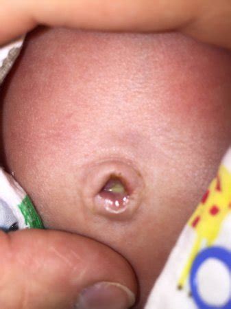 Until the cord falls off. Umbilical cord infected? Please help - Page 3 - BabyCenter