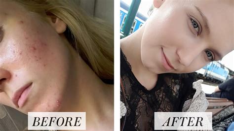 Similar to the facebook & instagram algorithm, reddit loves posts that are getting extremely high engagement. Woman's Before and After Accutane Photos Go Viral on ...