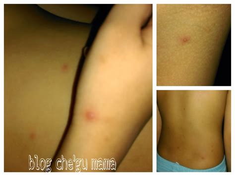 Maybe you would like to learn more about one of these? ini BeLOg Che' Gu MaMa...: CHICKENPOX SEWAKTU MENGANDUNG ...