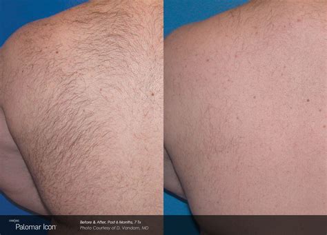 A lot of hair seems to fall out after each treatment. Laser Hair Removal | Lucencia Medical