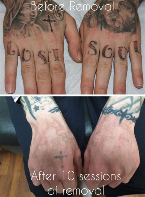 The amount of sessions needed is dependent on there are many places in town one can go to get an unwanted tattoo removed. Laser Tattoo Removal - Everything You Need to Know