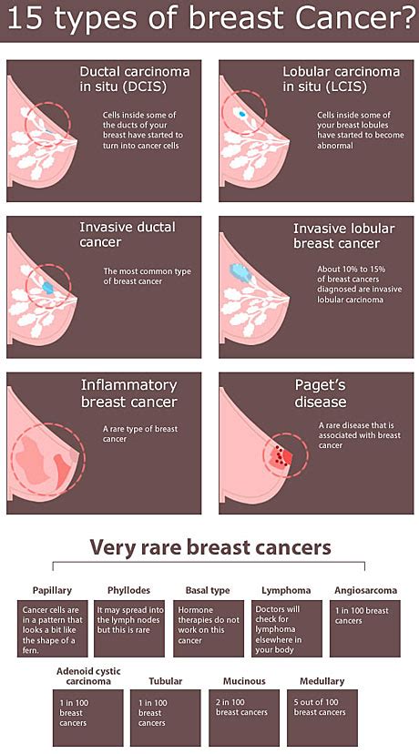Don't know how i missed it! What is Breast Cancer- Causes, Types, Prevention and Diagnosis